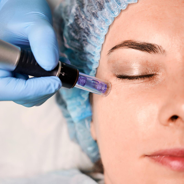 What is Microneedling Treatment?